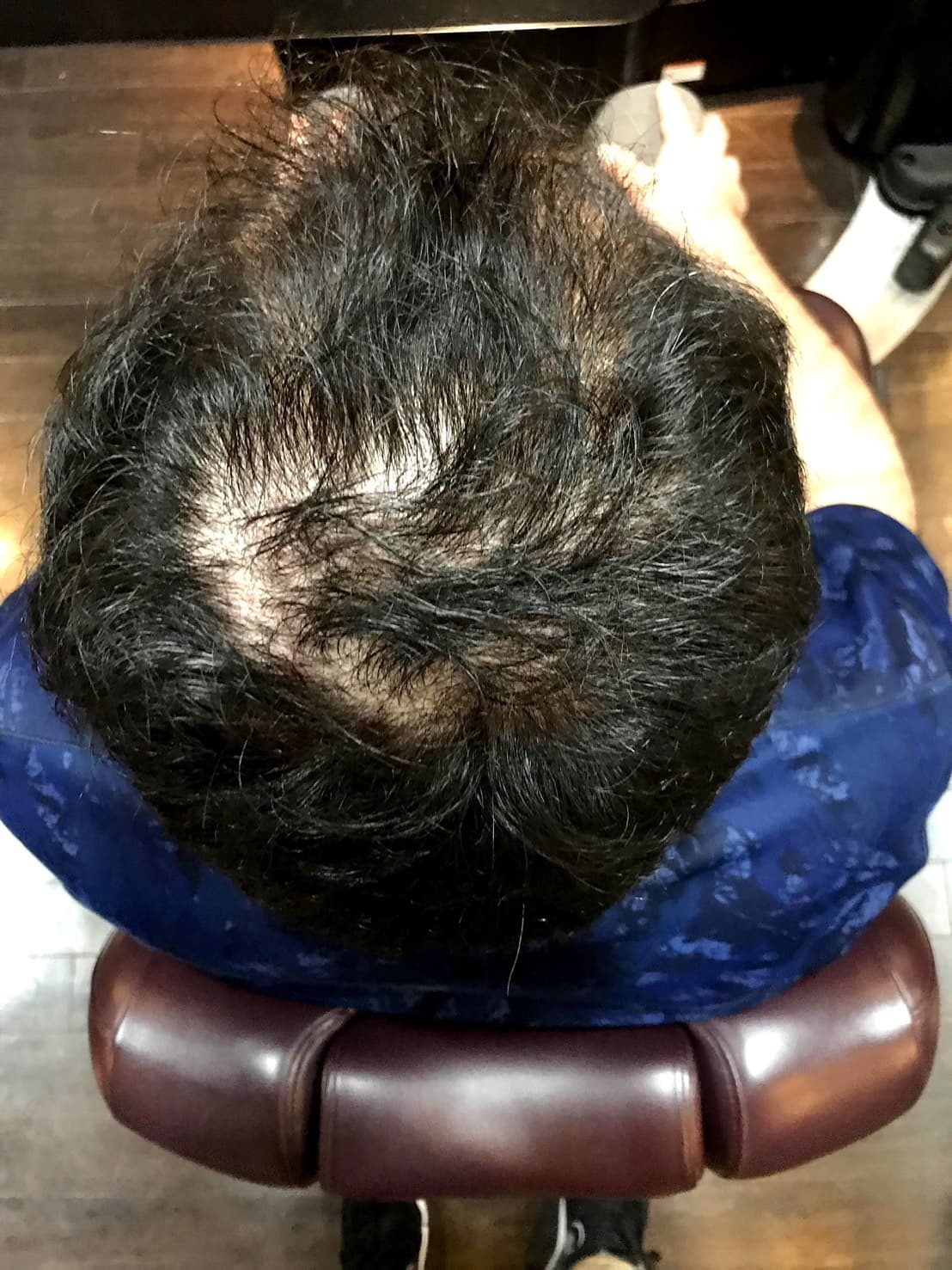 施術前の頭皮記録
